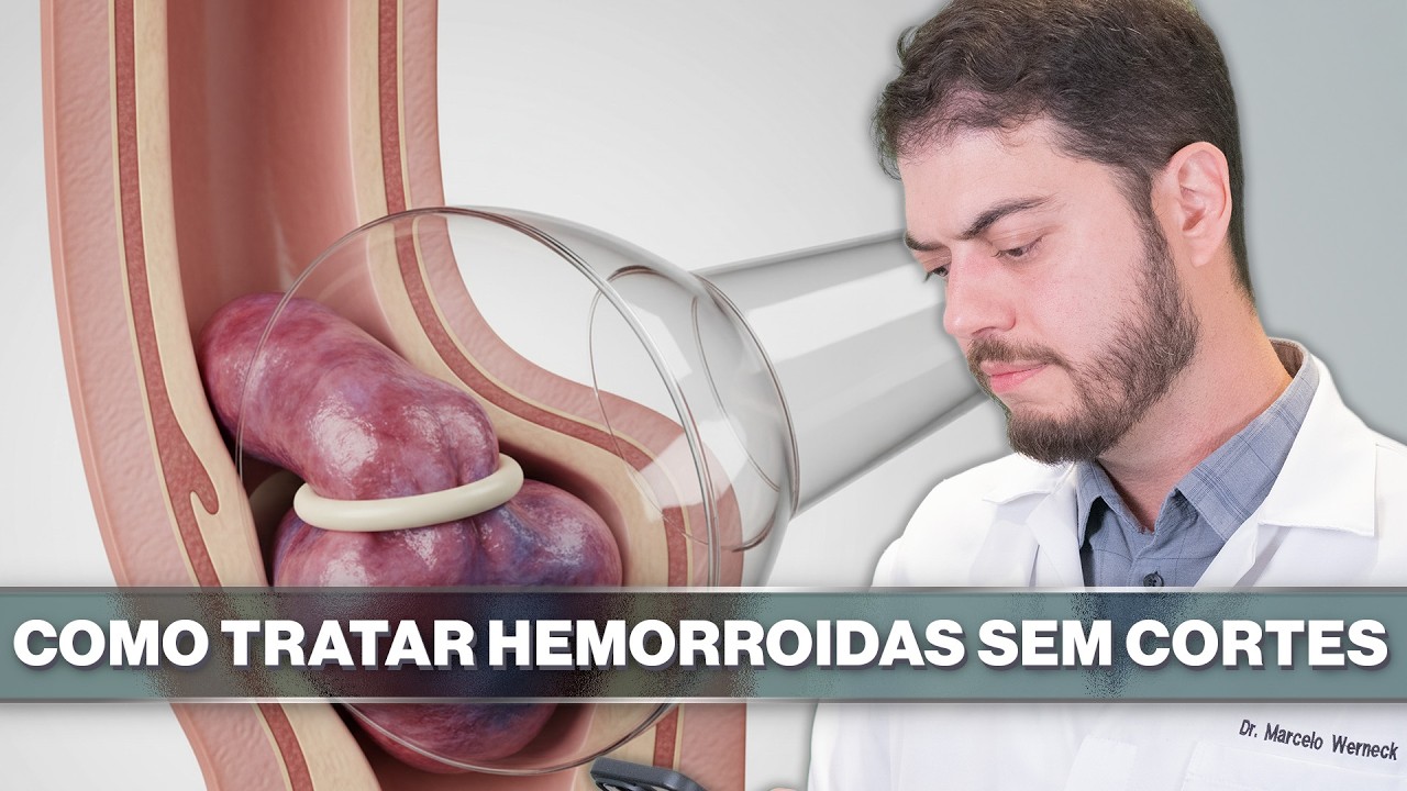 Ligadura Elástica: Como Tratar Hemorroidas Sem Cirurgia - YouTube
