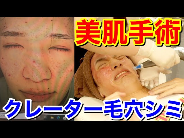 美肌整形 毛穴クレーター簡単に消える手術4連発で驚きの結果に Youtube 美肌整形 毛穴クレーター簡単に消える手術4連発で驚きの結果に Youtube