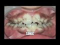 Black stains on teeth   dentist can help you