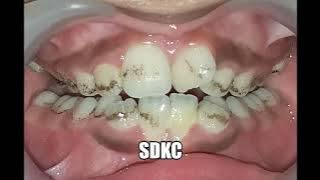 Black stains on teeth  - Dentist can help you