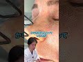 フラクショナルCO2レーザーはアメリカ皮膚科学会でも推奨されています！