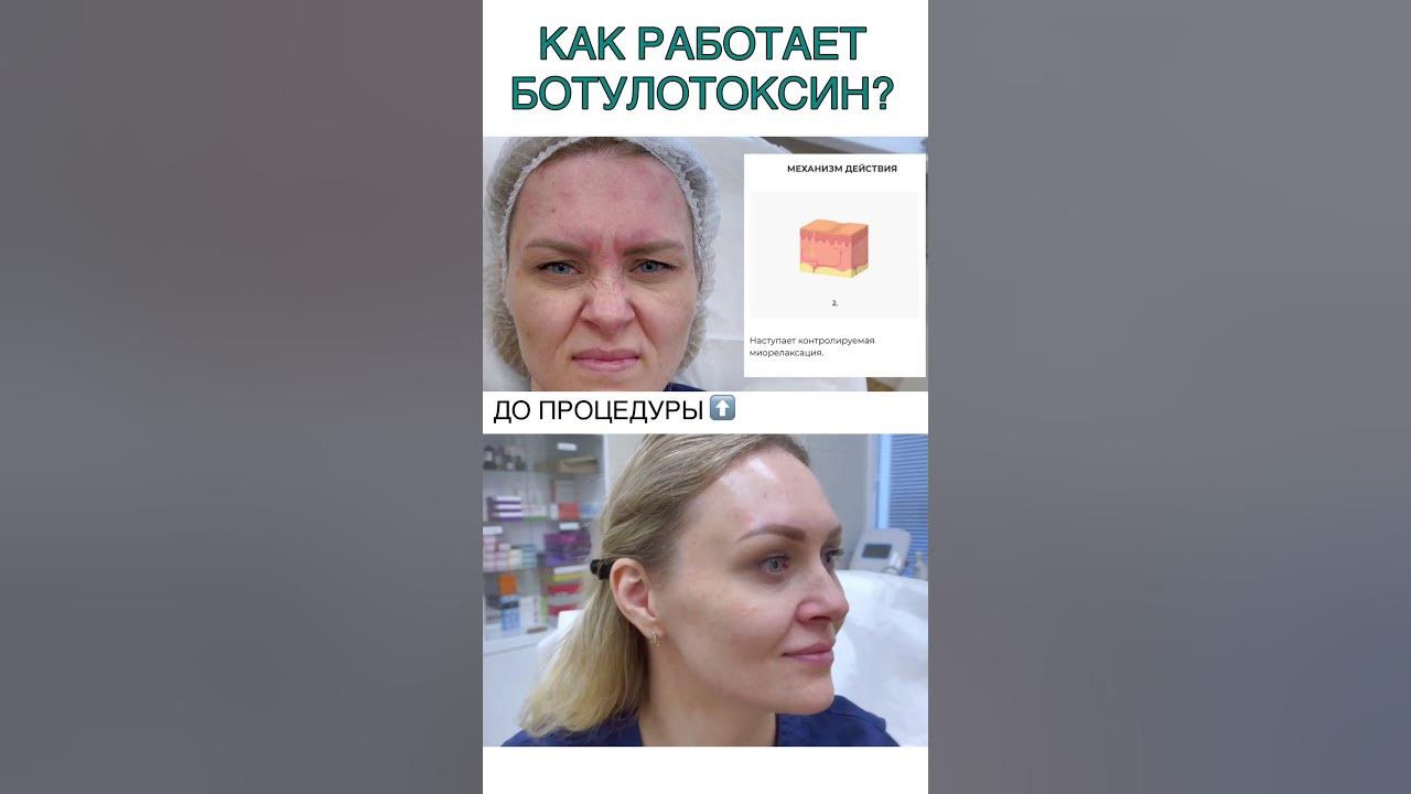 Миотокс отличие от ботокса. Как работает ботокс. миотокс препарат. миотокс реклама. миотокс лого.