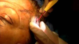 Temporal brow lift and upper eyelid blepharoplasty