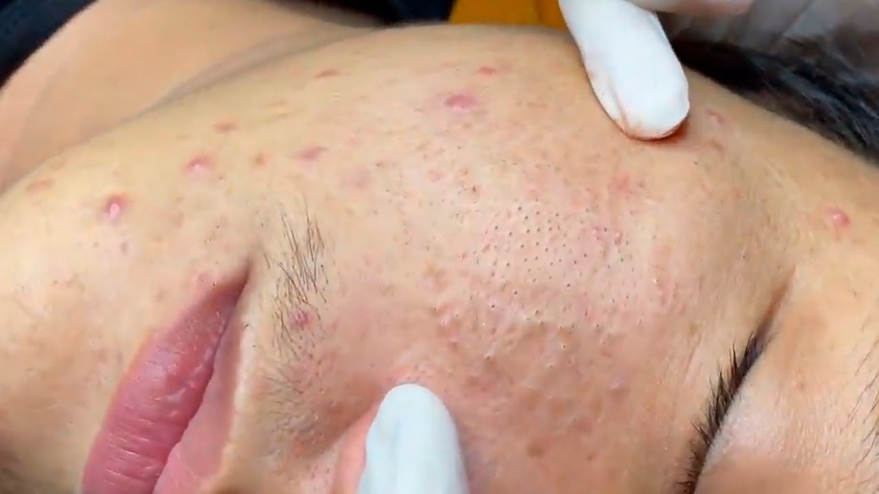 Tirando muitos cravos no Rosto - Vídeo relaxante de cravos no rosto ...