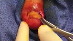 Worst Ingrown Toenails on YouTube - Ingrown Nails