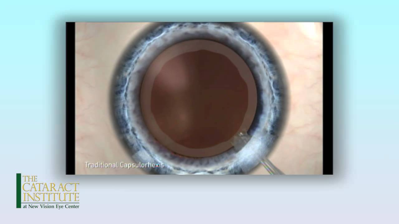 Laser Cataract Surgery at New Vision Eye Center - YouTube