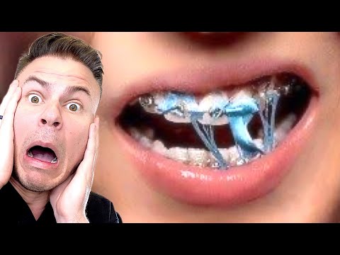 וִידֵאוֹ: האם לעיסת קשיות פוגעת בשיניים?