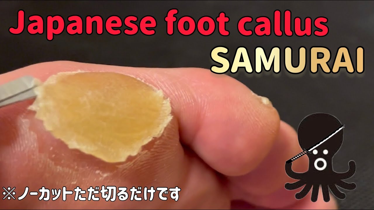 Satisfying Thick foot callus removal by Japanese Samurai YouTube