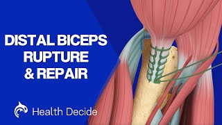 Distal Biceps Rupture and Surgical Repair - 3D Animation