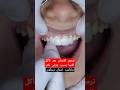 تلبيس اسنان زيركون بعد تآكل طبقة المينا