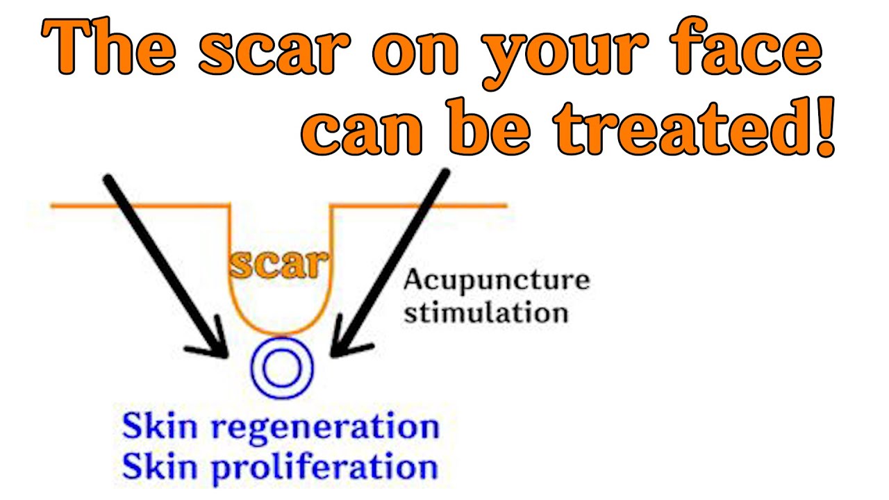 ENG) Principle of scar treatment with acupuncture. YouTube