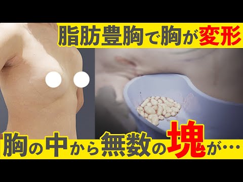 変形した胸を治す！脂肪注入でできたしこりを全部取る！
