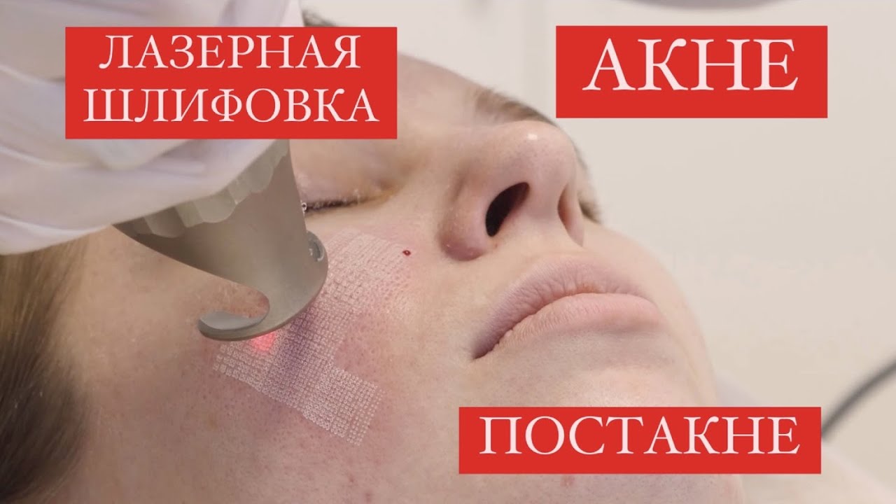 АКНЕ / ПОСТАКНЕ / ЛАЗЕРНАЯ ШЛИФОВКА КОЖИ