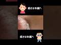 でっかい角栓とれた