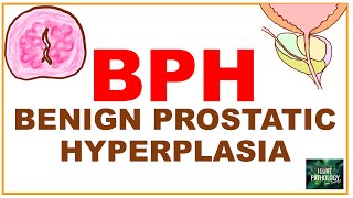 Benign Prostatic Hyperplasia ( BPH) etiopathogenssis, Pathology & clinical features