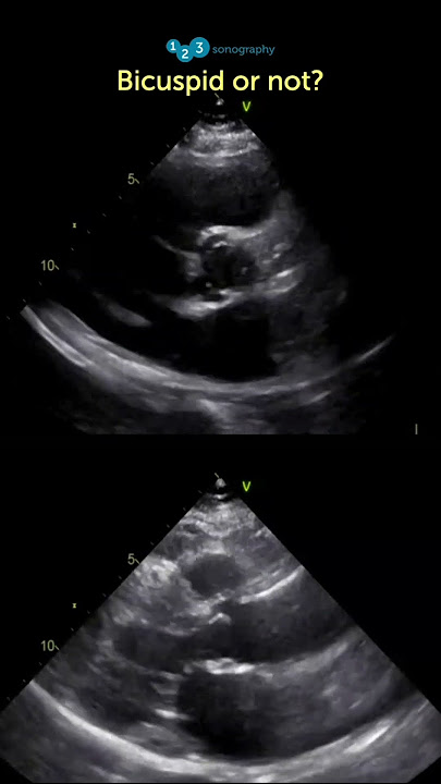 Echo Pearls: Is the aortic valve bicuspid? #echocardiography #123sonography #aorticvalve #echocases