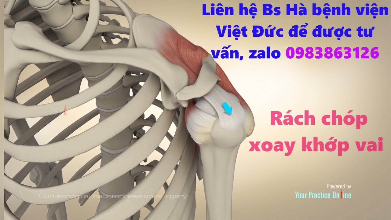 RÁCH GÂN CƠ CHÓP XOAY KHỚP VAI ( RÁCH GÂN TRÊN GAI ) - CHẨN ĐOÁN , ĐIỀU ...