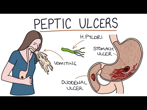 வயிறு மற்றும் சிறுகுடல் புண்களைப் புரிந்துகொள்வது