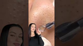Как избавиться от черных точек