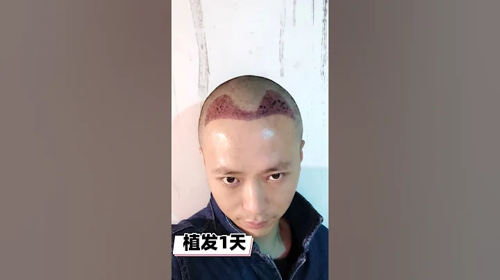 【植髮案例】M字脫髮、頭髮稀疏？植髮真實效果分享，脫髮有救了！| 植髮醫生續開聰 - 天天要聞