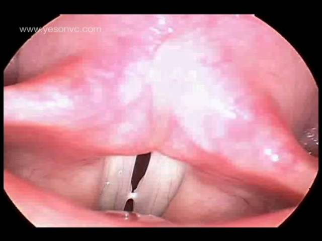 ejercicios para fortalecer los musculos de las cuerdas vocales