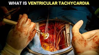 Understanding Ventricular Tachycardia: Causes, Symptoms, and Treatments