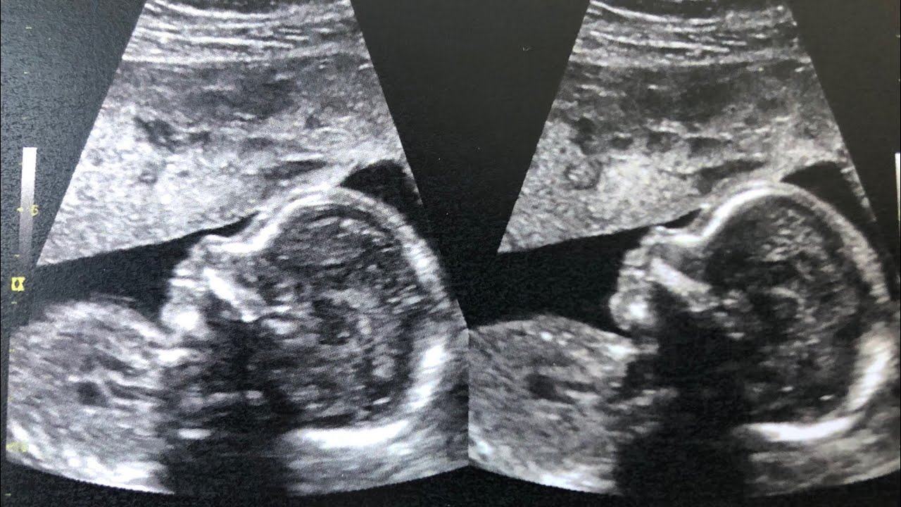 20 Week Anatomy Ultrasound Scan YouTube 20 Week Anatomy Ultrasound Scan YouTube