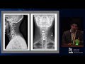 Mobi c failures in cervical arthroplasty patients   Varun Yadav, MD