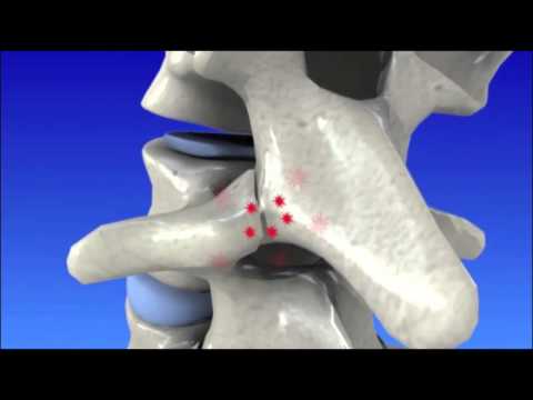 Operasi pinggang karena HNP (Hernia Nucleus pulposus). 