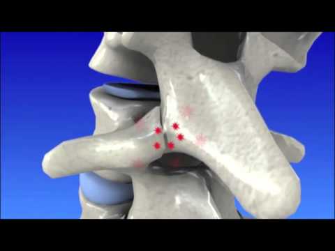 Degenerative Disc Disease - Spine Degeneration