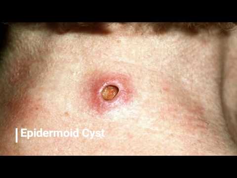 Trypophobia! Dermatology, Popaholics, Pops & Senile Comedones