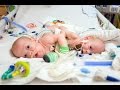 Rare Conjoined Twins Successfully Separated by Nemours Surgeons at Wolfson Children's Hospital