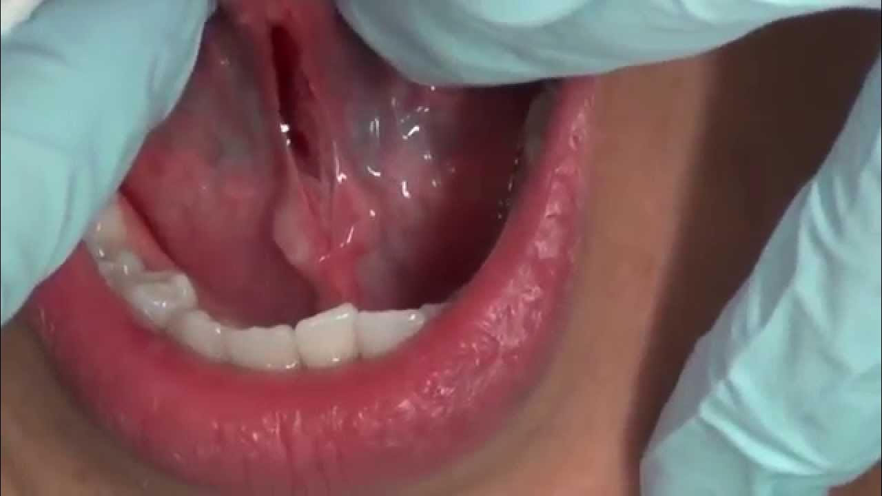 How to do Frenectomy YouTube