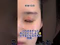 ぱちキワ+眉下傷跡どうなる?? #眉下切開 #眉下リフト #整形 #ダウンタイム