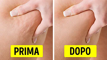 Come eliminare la cellulite in pochi mesi?