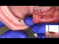 Measuring Tissue Height for LOCATOR and LOCATOR R-Tx Abutments