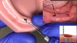 Measuring Tissue Height for LOCATOR and LOCATOR R-Tx Abutments