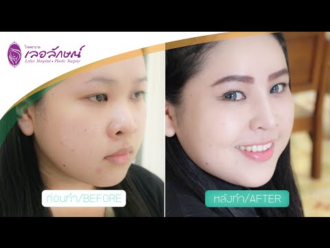 คุณอุ้ย รีวิวเสริมจมูก ความประทับใจจากลูกค้าที่มาใช้บริการโรงพยาบาลเลอลักษณ์