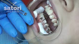 Фиксация брекетов на зубы