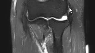 Extensor Digiti Minimi Tear - Mri Elbow And Forearm