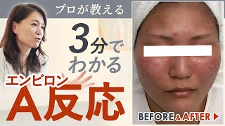 【プロが教える】3分で分かるA反応 【エンビロン レチノイド反応】