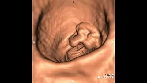 CT colonography (virtual colonoscopy) Sigmoid tumour