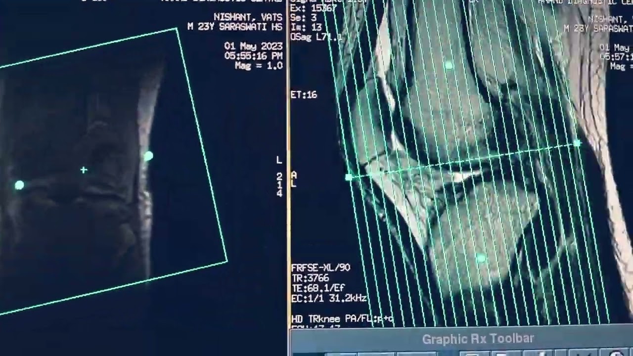 MRI knee joint sequences n planning with cartilage planning n post processing on GE 1.5T creator