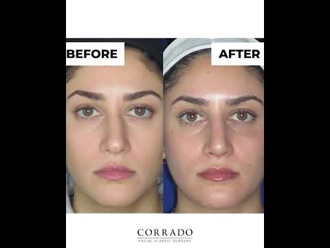 Video thumbnail: Crooked Nose Rhinoplasty Results: Before & After | Dr. Corrado #shorts #rhinoplastyspecialist · Dr. Anthony Corrado