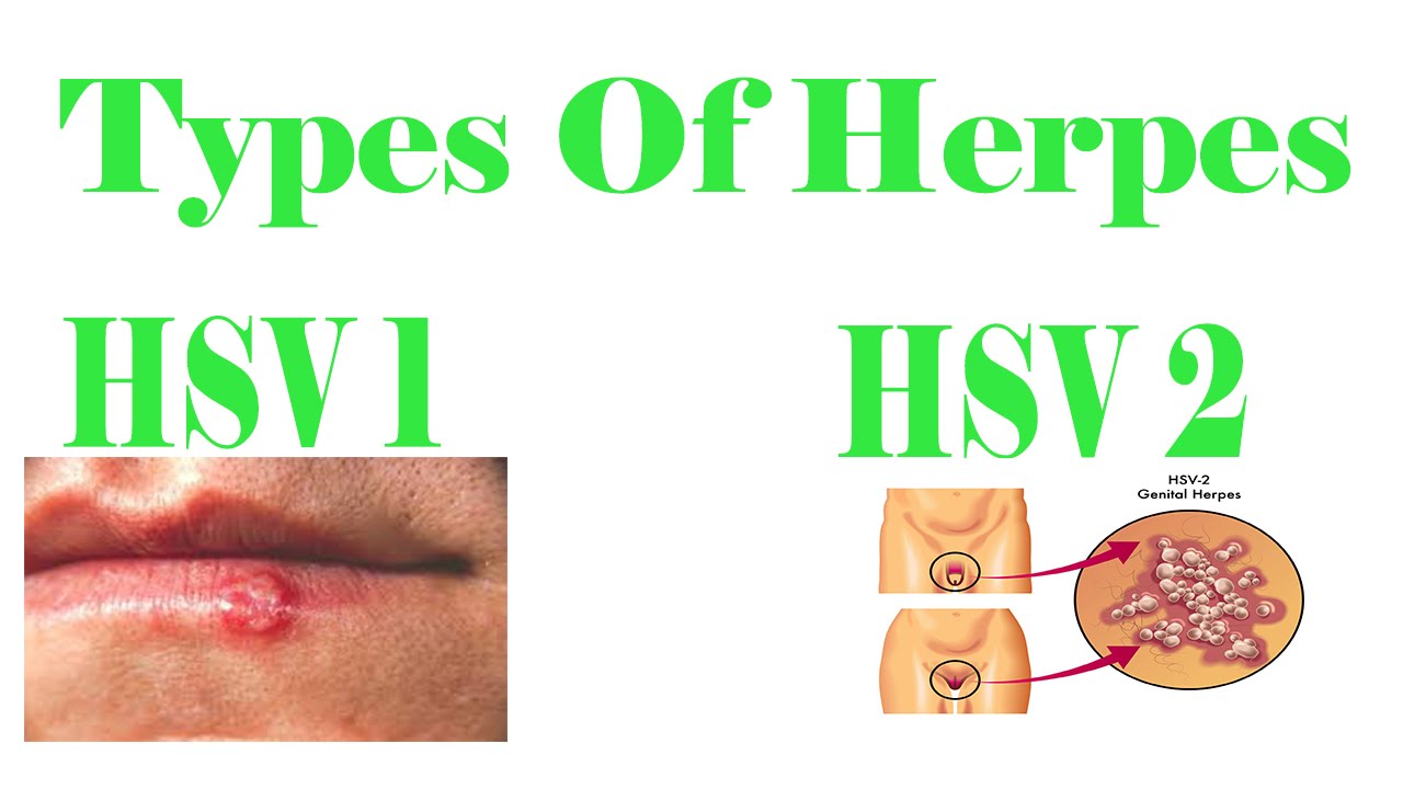 Types Of Herpes Herpes Simplex 1 Hsv 1 Herpes Simplex 2 Hsv 2