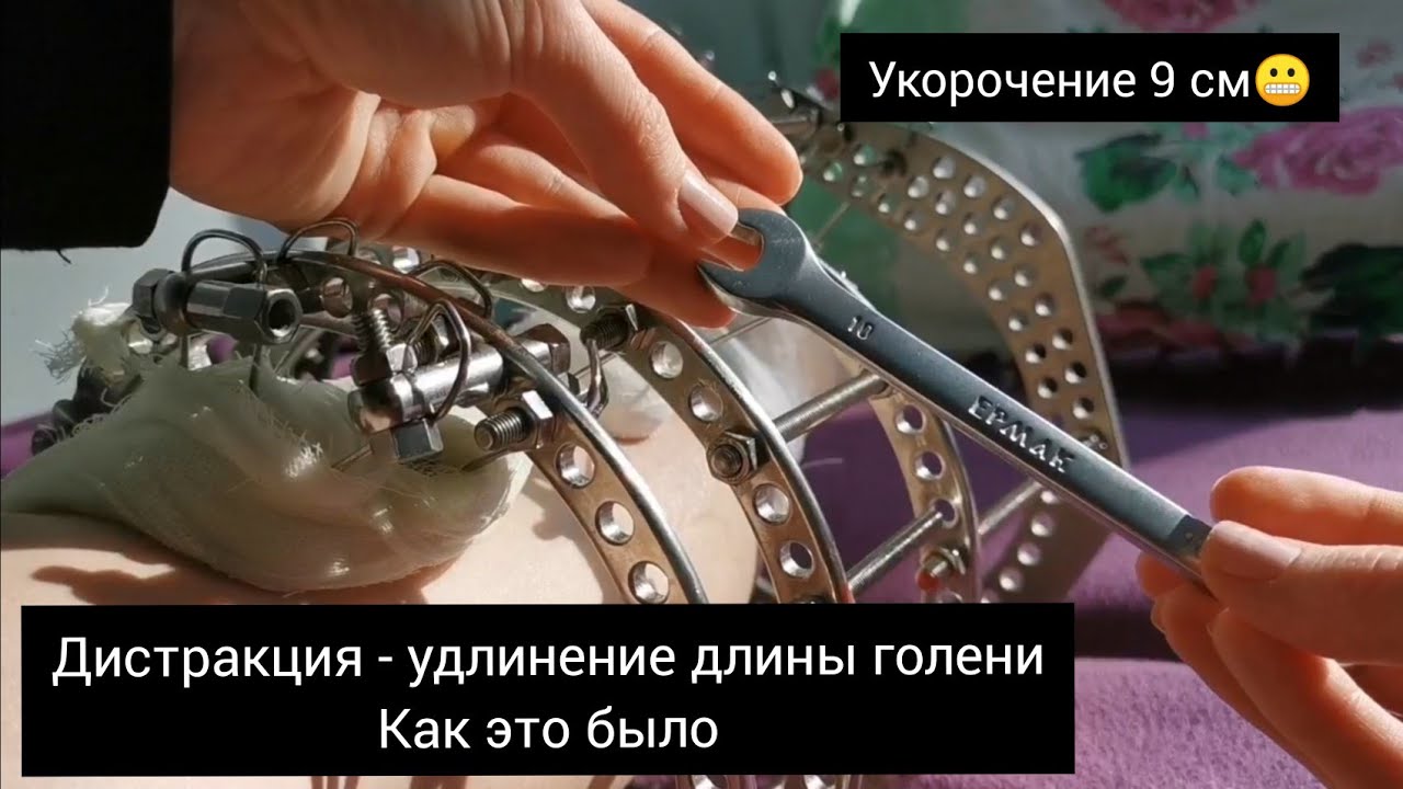 Удлинение ноги в аппарате Илизарова. Дистракция. - YouTube