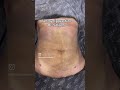 Tummy liposuction before & after by dr Saleem