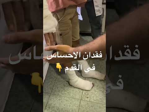 سقوط القدم ضعف الاحساس