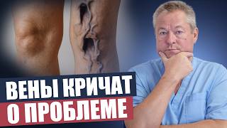 видео: Варикозная сетка: как убрать ее навсегда без инъекций картинка: Варикозная сетка: как убрать ее навсегда без инъекций