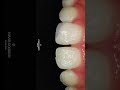 Amazing broken tooth transformation #laminate #veneers #koreadentist